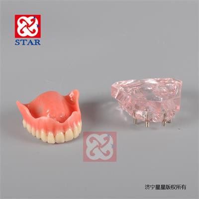 4個(gè)微型種植釘，上頜一尺修復(fù)。M6001